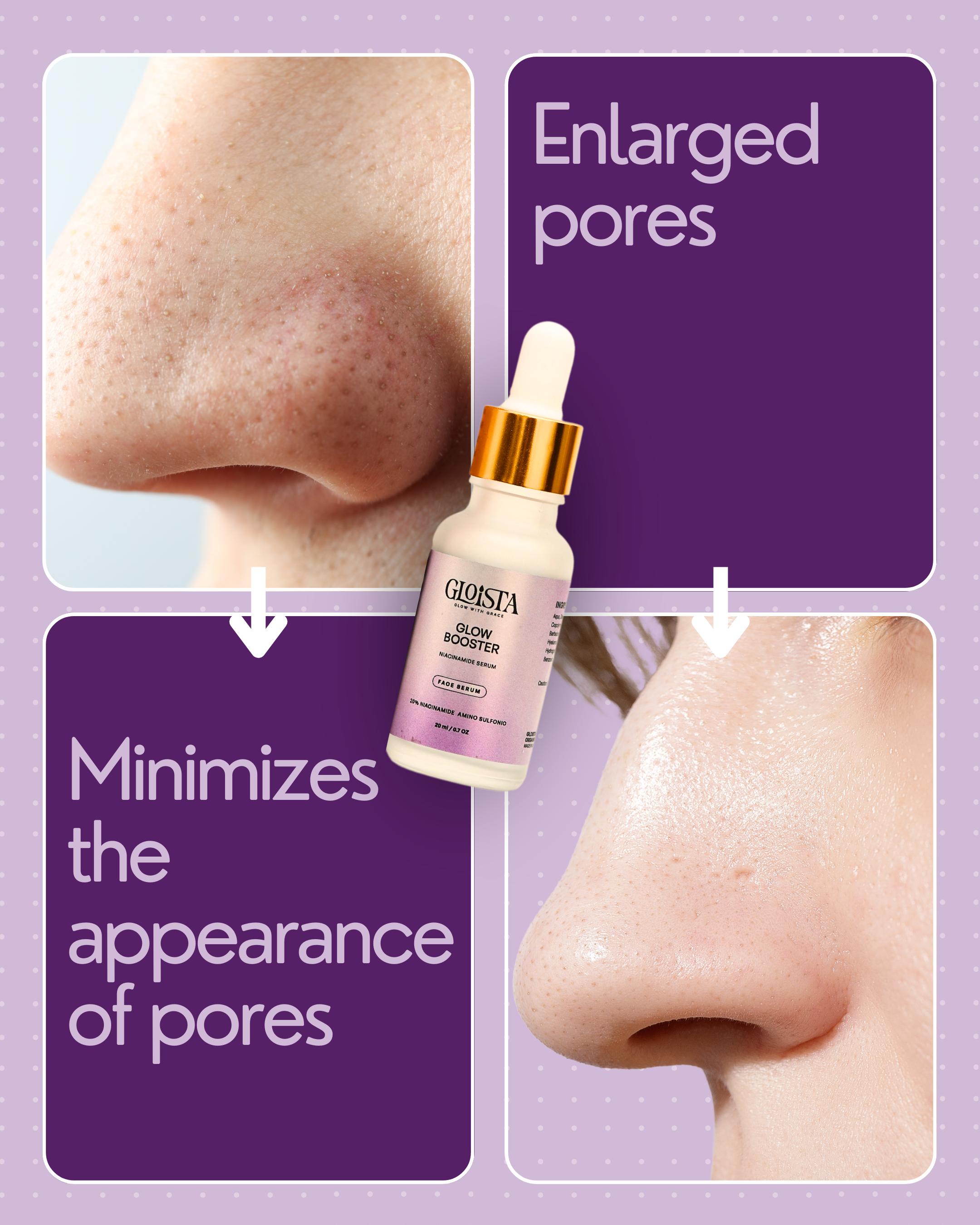 Enlarged Pores