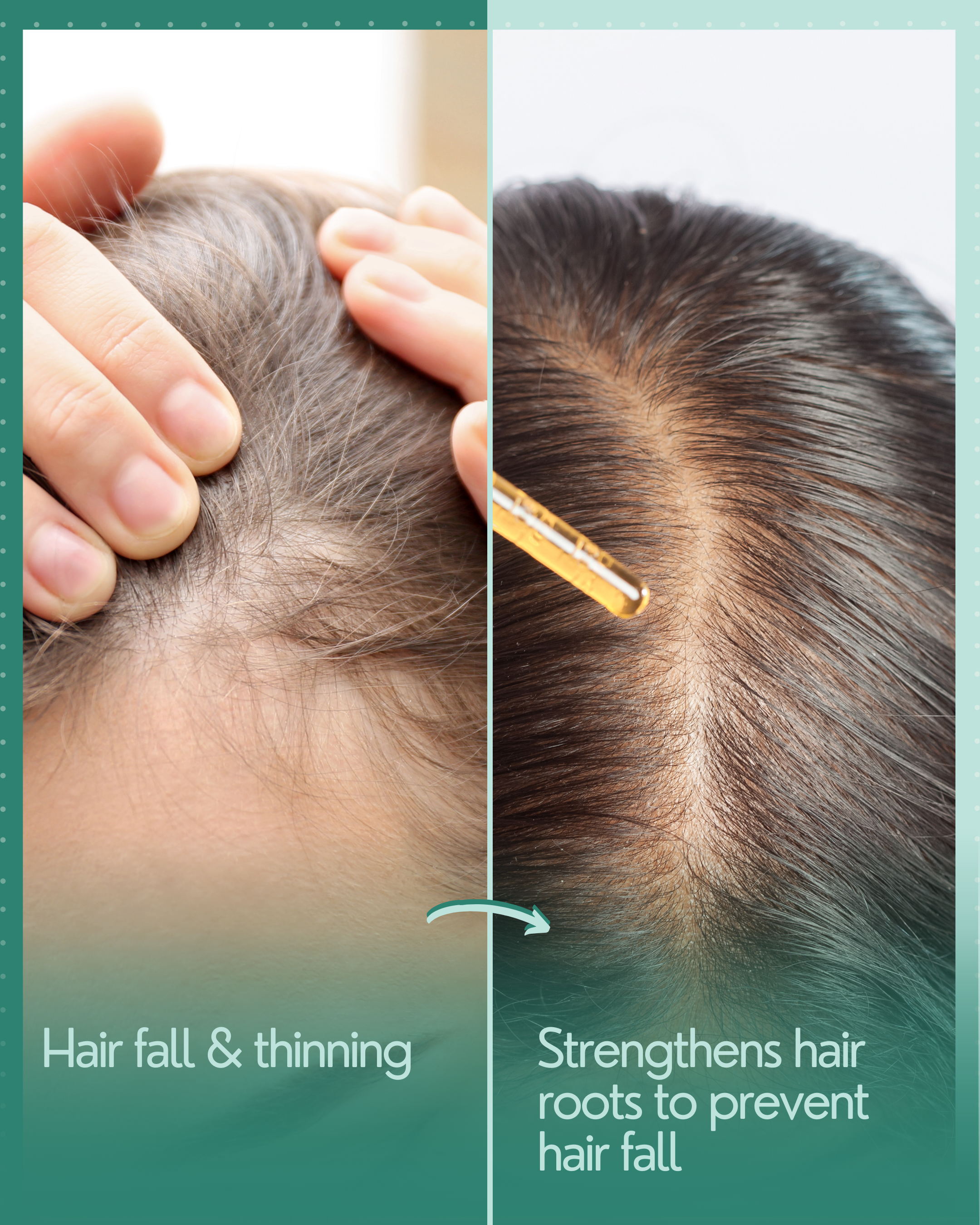 Hair Fall & Thinning